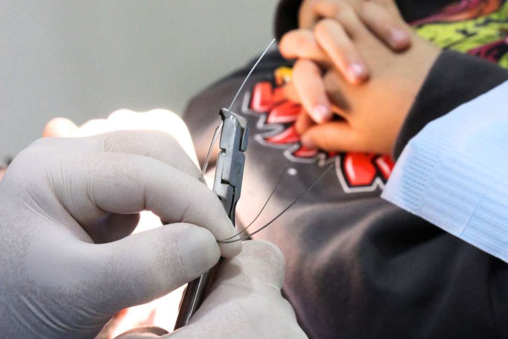 arco dental para ortodoncia con brackets