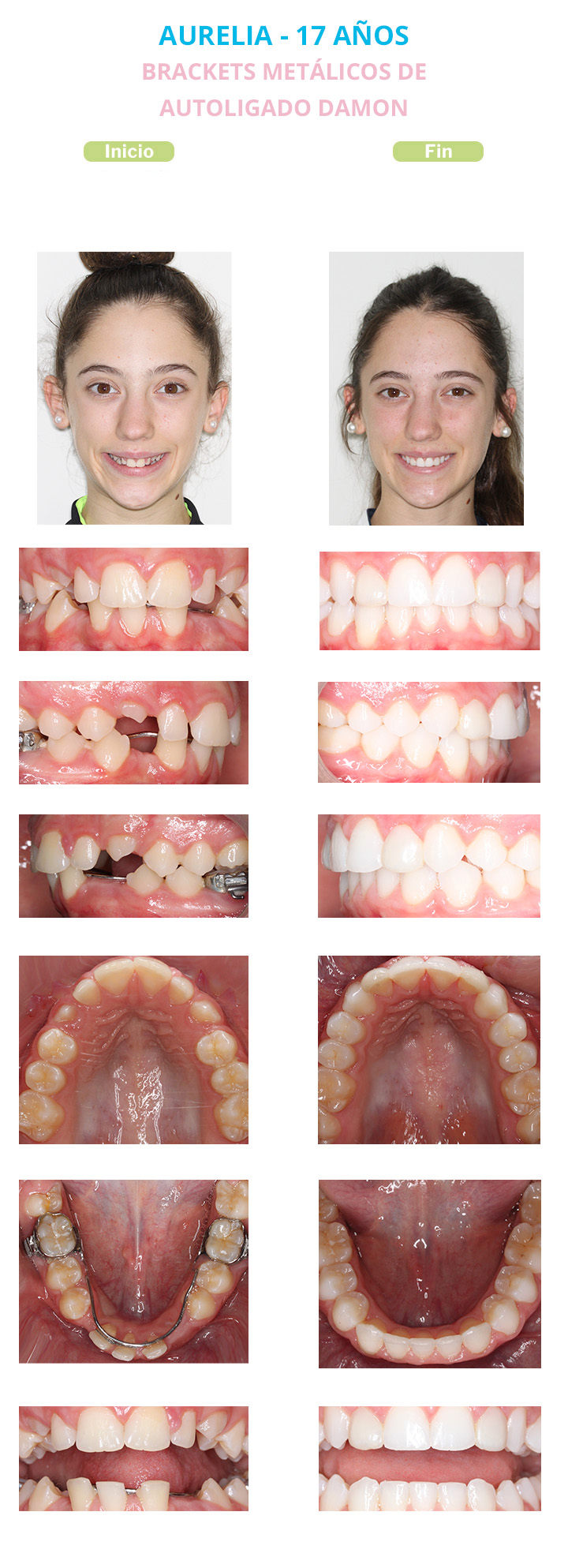 antes y despues de brackets autoligado damon aurelia