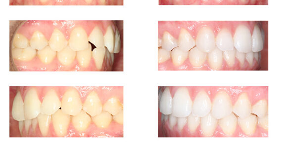 Erika, 31 años, Invisalign