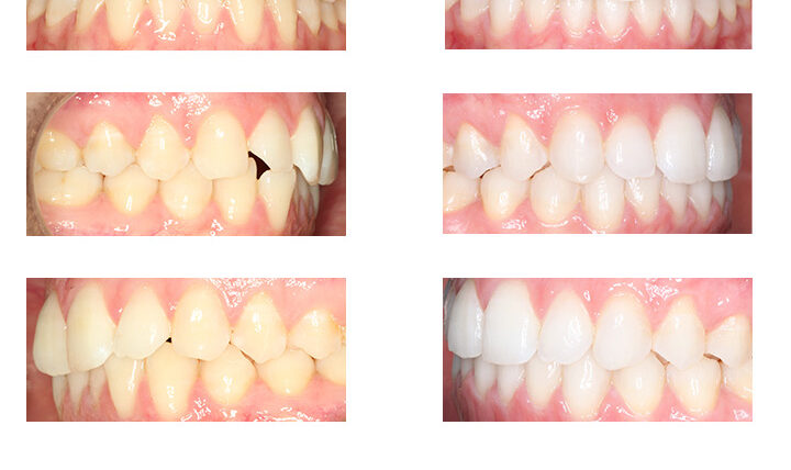Erika, 31 años, Invisalign