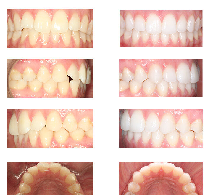 Erika, 31 años, Invisalign