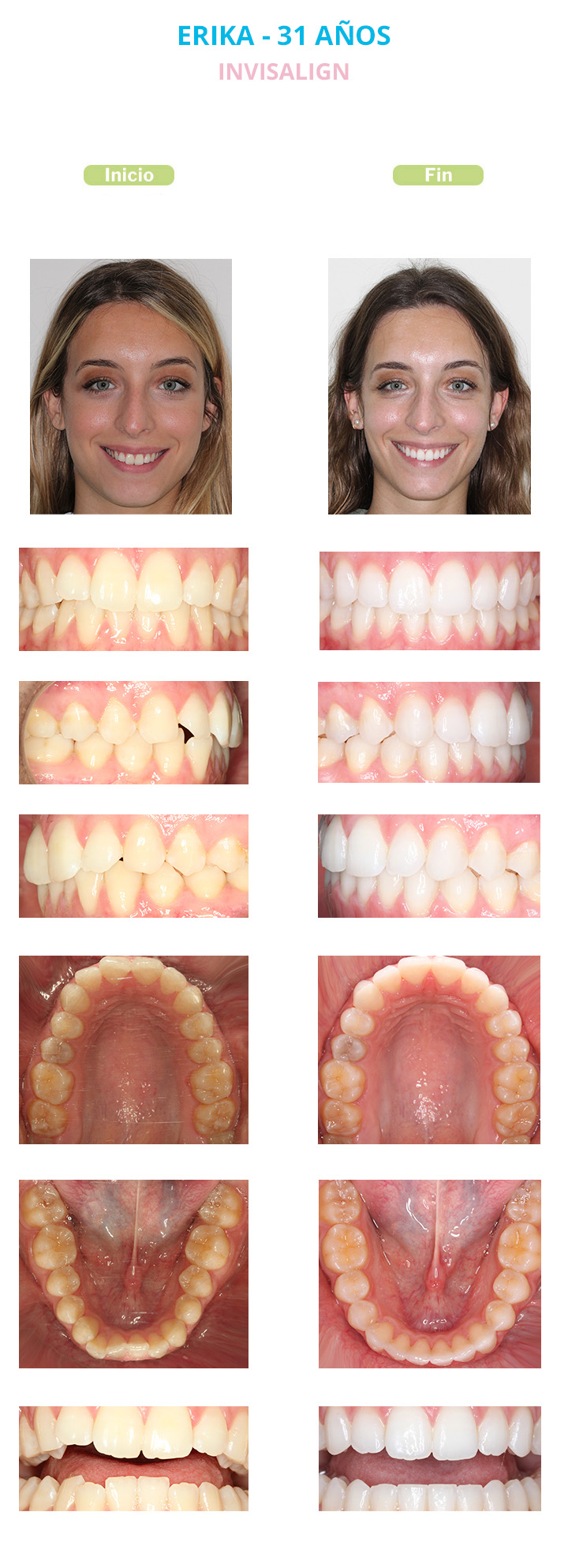 antes y despues invisalign