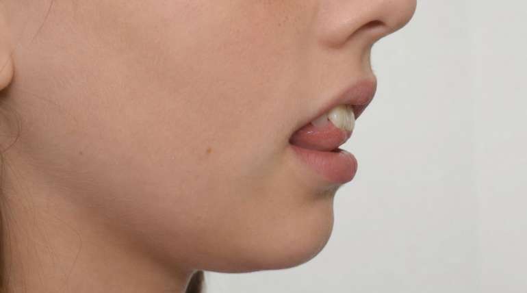¿Puede la posición de la lengua mover los dientes?